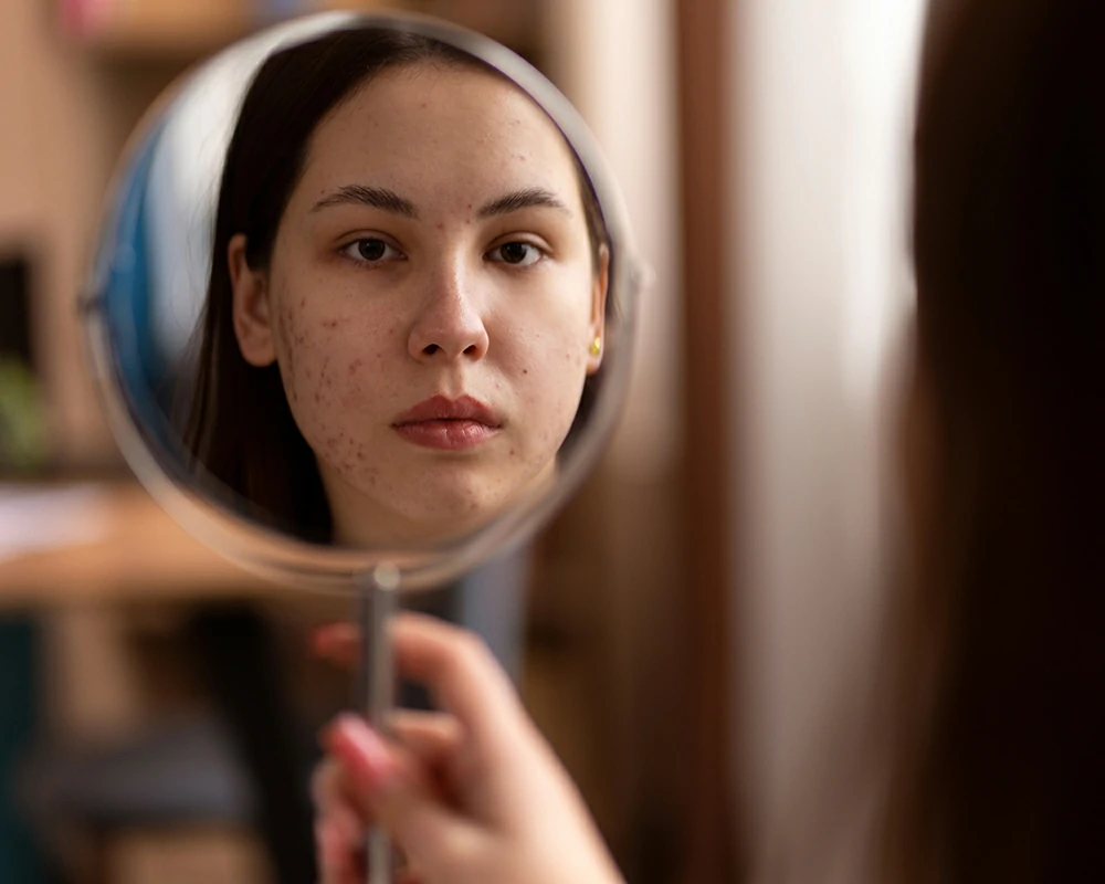 10 สาเหตุที่มาของสิว ทำไมสิวถึงไม่หายสักที?