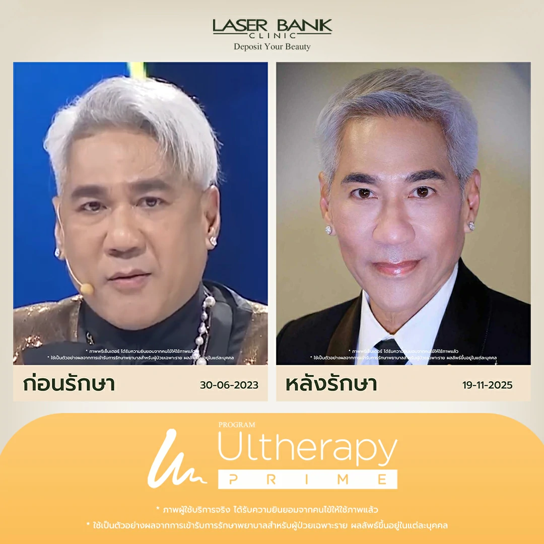 ผลลัพธ์ของUlthera