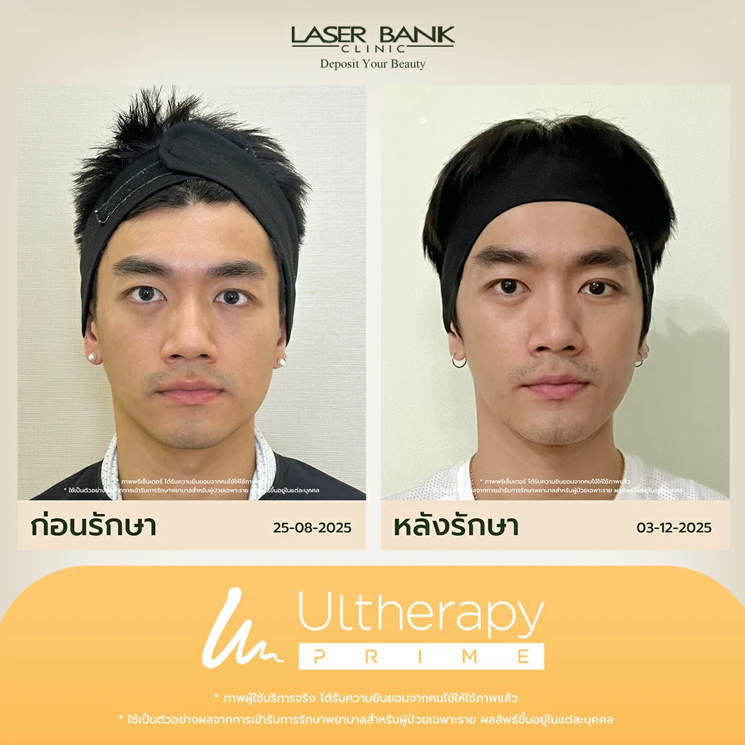Before & After หลังจากทำUlthera