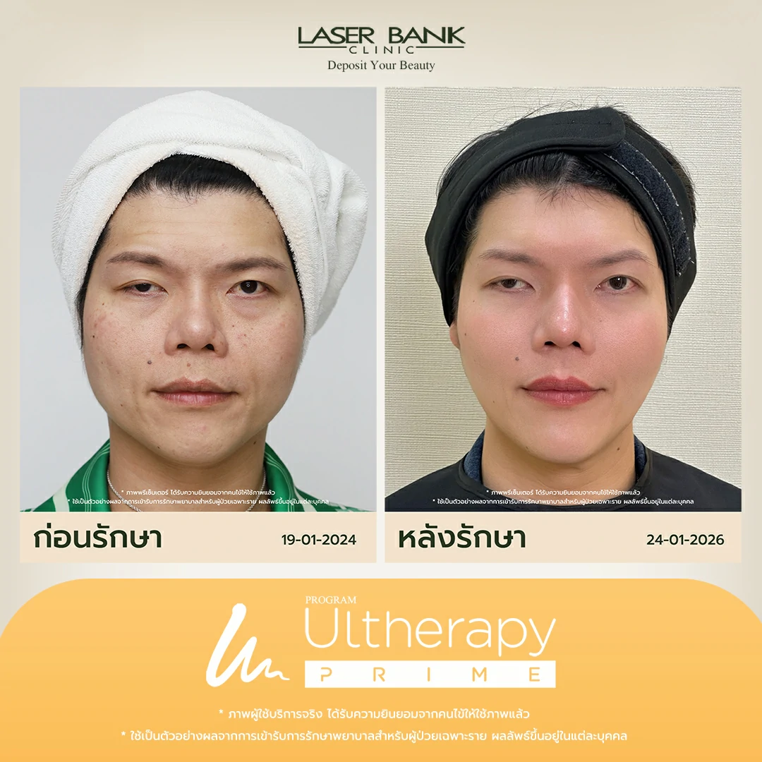 หลังจากทำUltheraที่ดูยกขึ้นสำหรับผู้ที่ดูมีอายุ