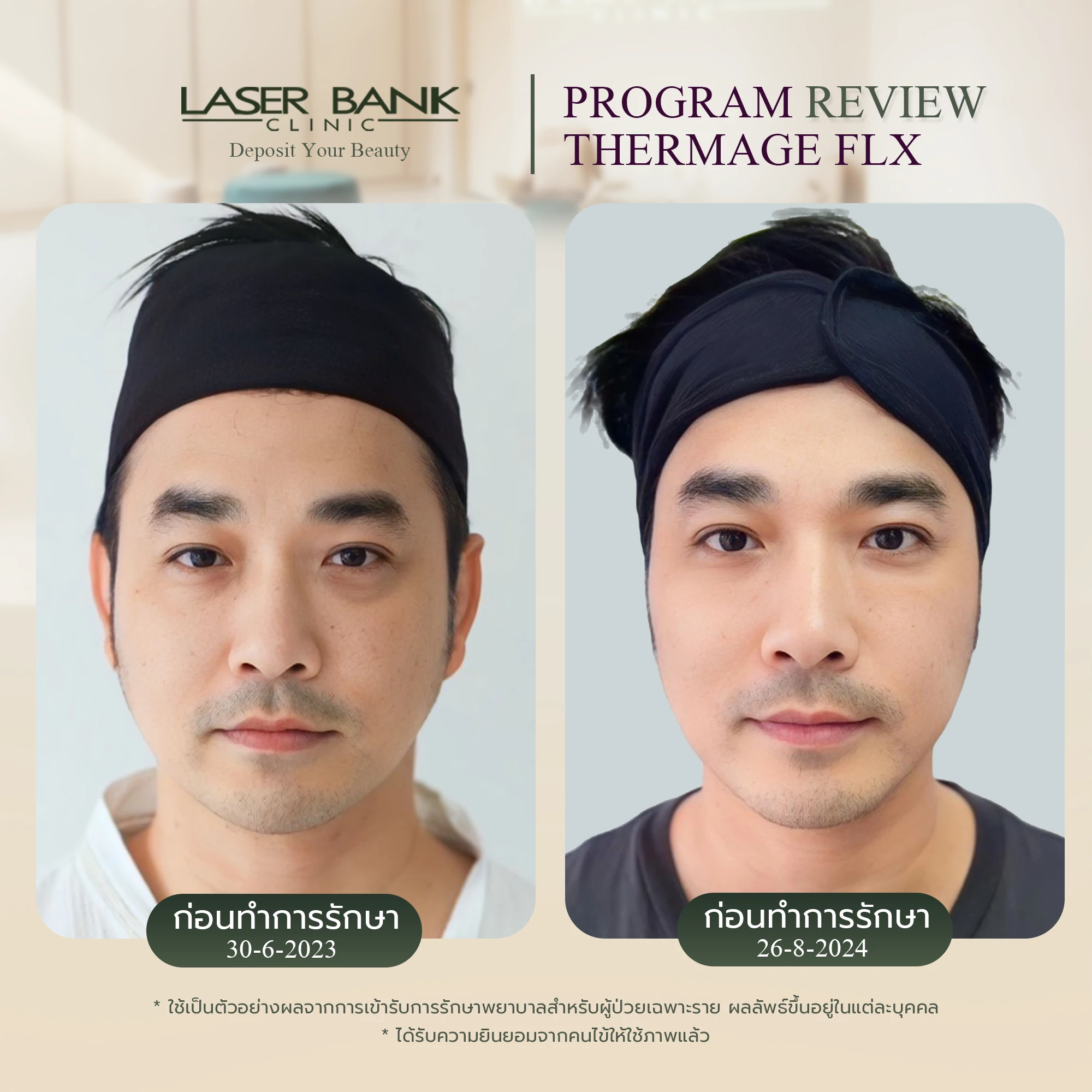 Thermage FLX 900 Short ผลลัพธ์