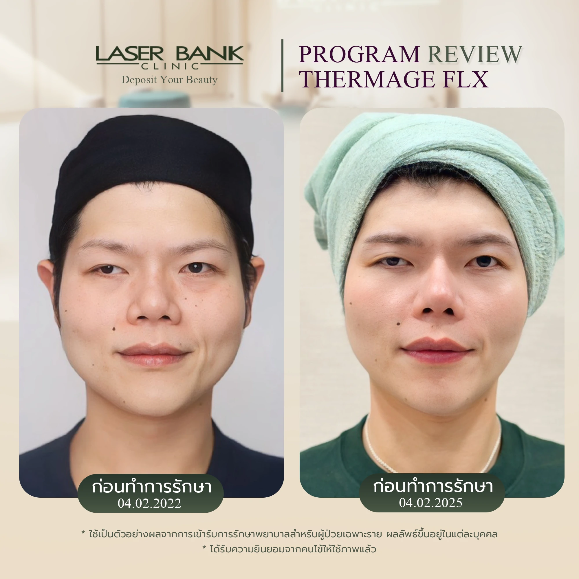 Thermage FLX 900 Short ผลลัพธ์