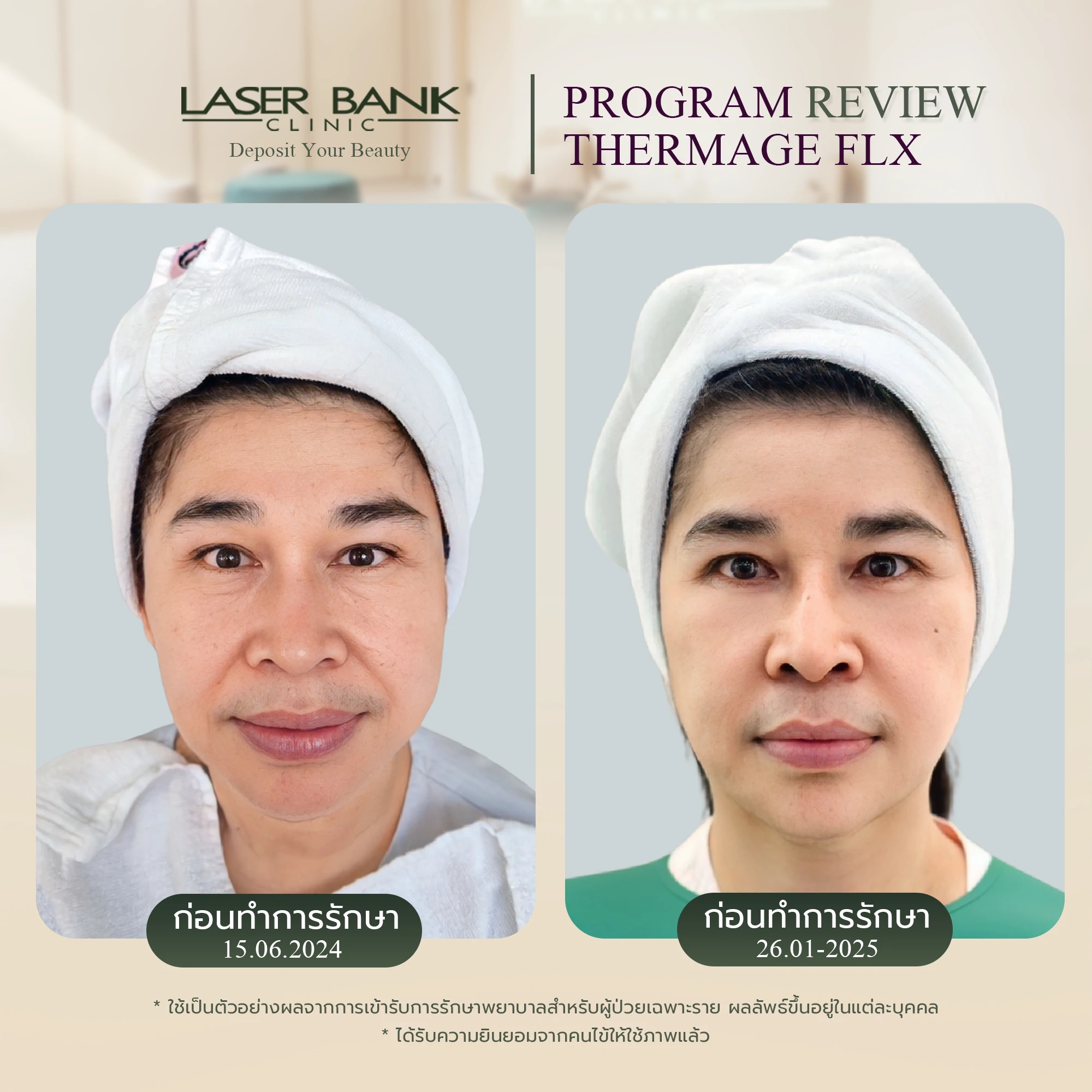 Thermage FLX 900 Short ผลลัพธ์