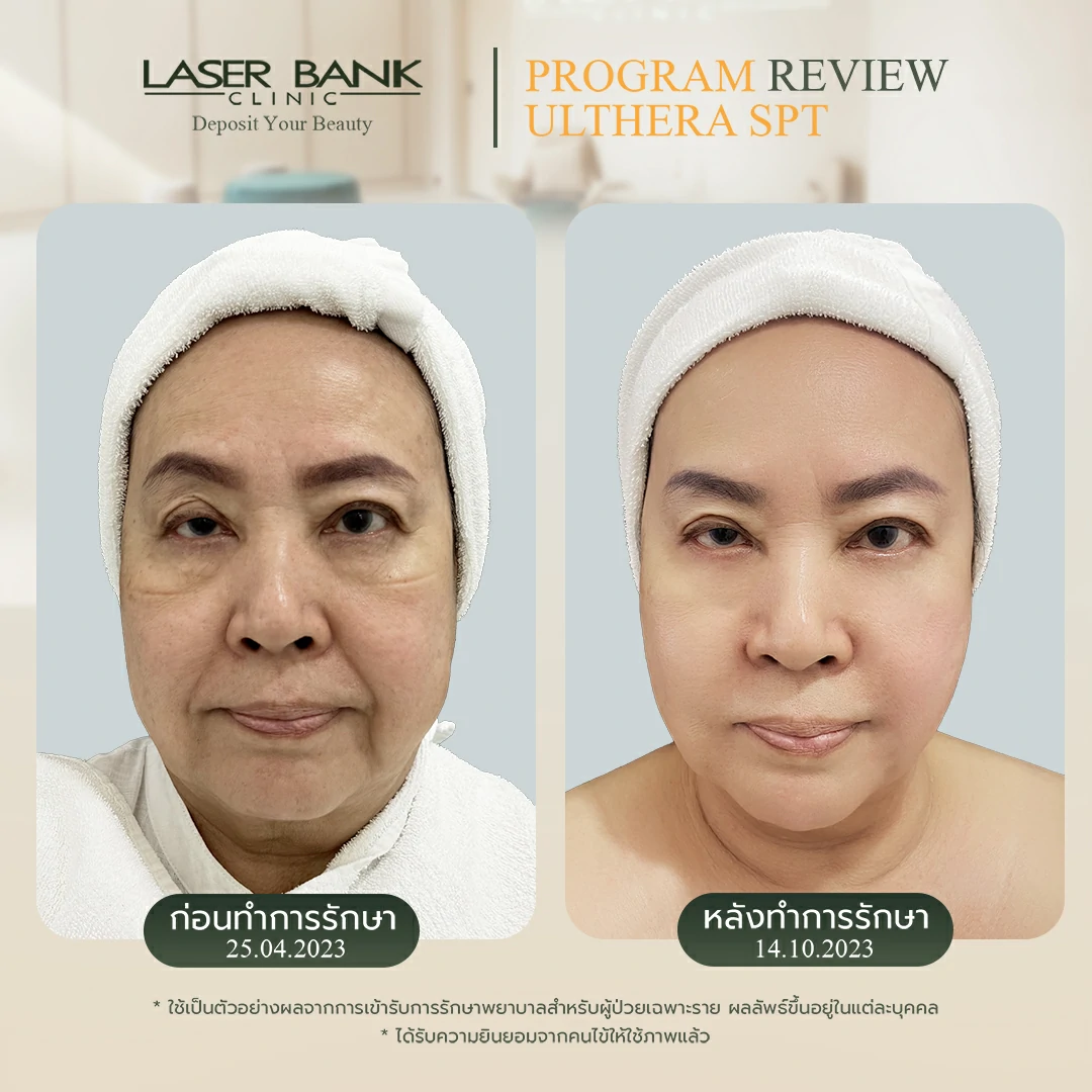 หลังจากทำUltheraที่ดูยกขึ้นสำหรับผู้ที่ดูมีอายุ