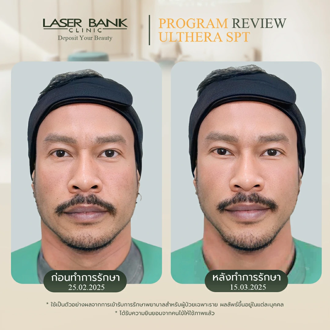 ยกกระชับด้วยUltheraสำหรับผู้ชาย